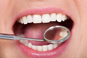 Healthy teeth with handheld dental mirror