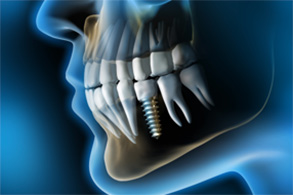 X-ray of single implant