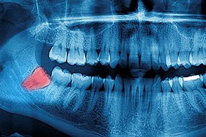 X-ray of wisdom tooth